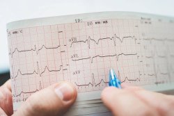 EKG as a Routine Screening Test